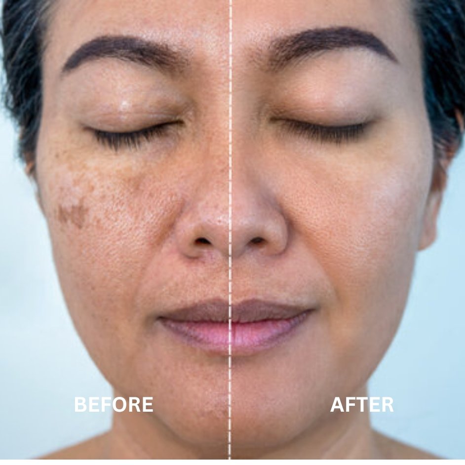 Pigmentation Treatment